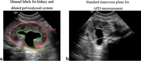 Renal Images Obtained From B Mode Ultrasound With A Convex Probe A The