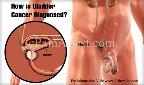 About half of bladder cancer cases show up in these. How is Bladder Cancer Diagnosed?