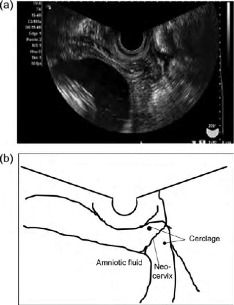 A Transvaginal Ultrasound Image For One Pregnant Patient After Rat