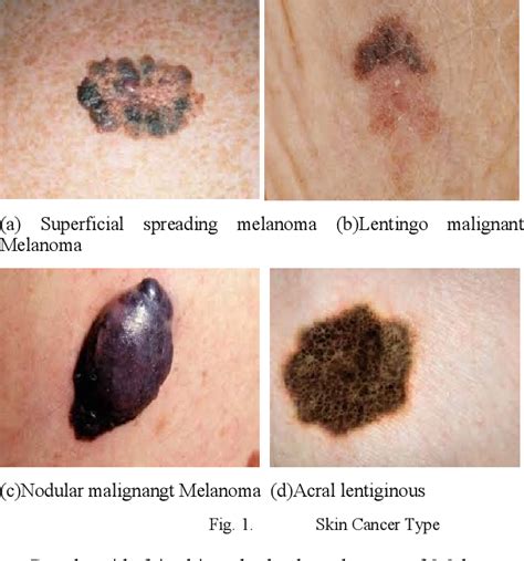 Figure 1 From Automated Melanoma Types And Stages Classification For