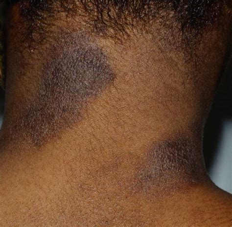 10 Most Common Skin Rashes On Black Skin Where