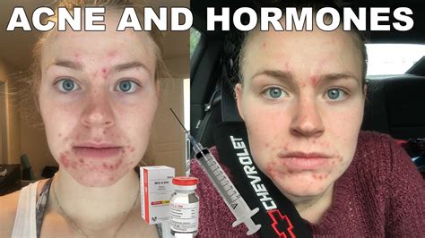 Acne From Steroids How I Take Care Of My Skin Amie Youtube