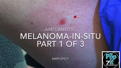 Amelanotic Melanoma In Situ Patient Profiles Tamara Part 1 Of 3