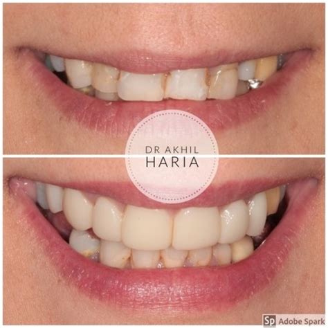 Case Of The Month Composite Bonding Eyes And Smiles Expert 5 Dentist In Friern Barnet N11