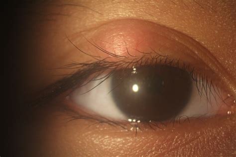 A Girl With An Asymptomatic Mass On Her Eyelid Consultant360