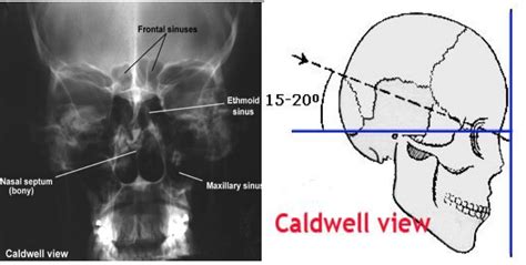 x ray caldwell view x ray nasal septum maxillary sinus