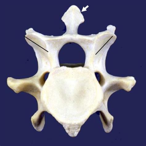 Lateral View Of The Cervical And Cranial Thoracic Vertebrae C1 T3