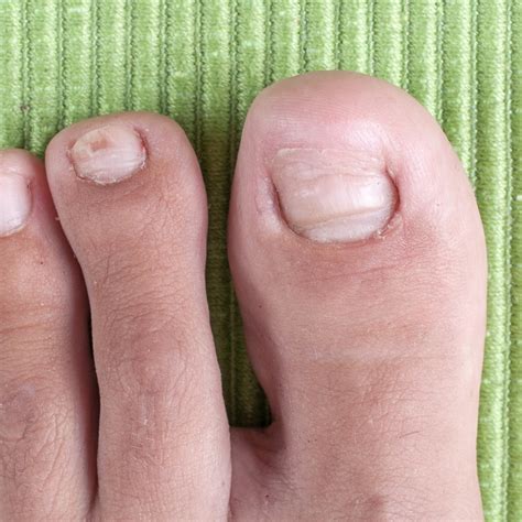 Ingrown Toenail Kensington Podiatry