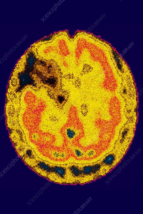 Stroke Brain Scintigraphy Stock Image C0306264 Science Photo