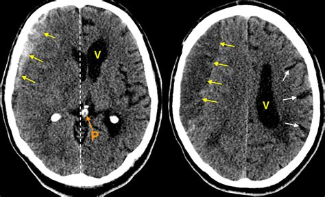 Acute On Chronic Subdural Haematoma Radiology At St Vincent S