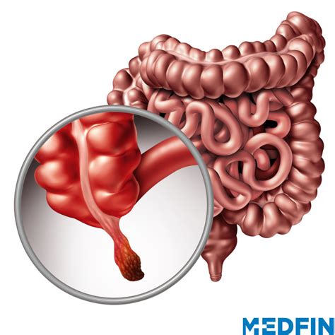 Appendicitis Causes Symptoms And Prevention Medfin