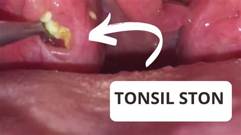 Tonsil Stones Removal Extracción De Tonsilolitos Youtube