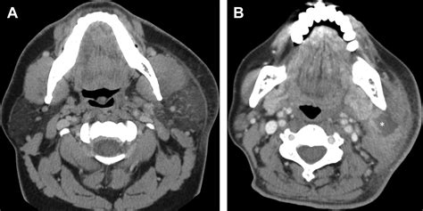 Parotid Gland Imaging Otolaryngologic Clinics Of North America