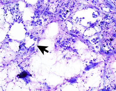Mesothelioma Cytology Pathology Outlines Flynn Gomer