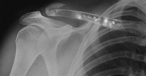 X Ray Of Packers Qb Aaron Rodgers Broken Collarbone Released Pic