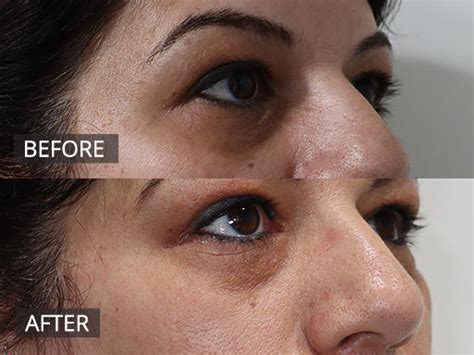 Xanthelasma Treatment Melbourne The Doc Cosmetic And Skin Clinic
