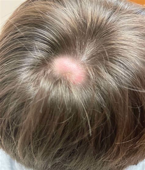 Scalp Nodule Associated With Hair Loss Mdedge Dermatology
