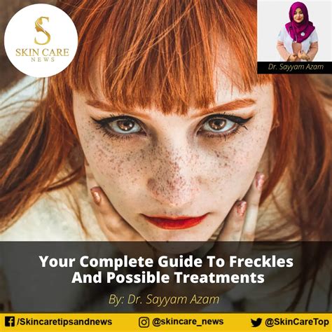 Your Complete Guide To Freckles And Possible Treatments