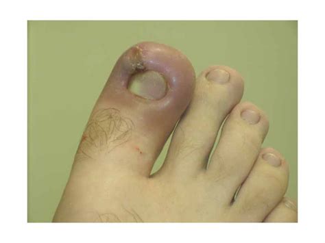 The Wikipremed Mcat Course Image Archive Infected Ingrown Toenail
