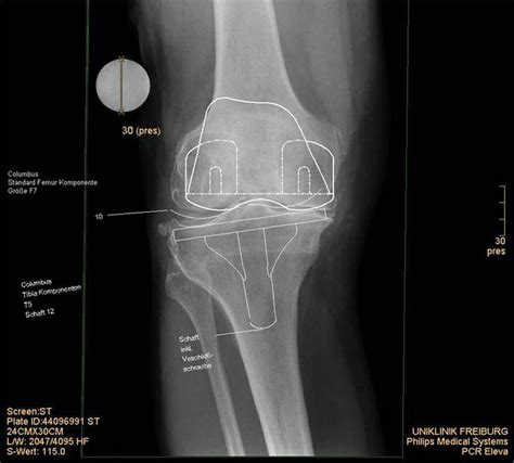 Digital Templating Of Knee Arthroplasty Anteroposterior Ap View With