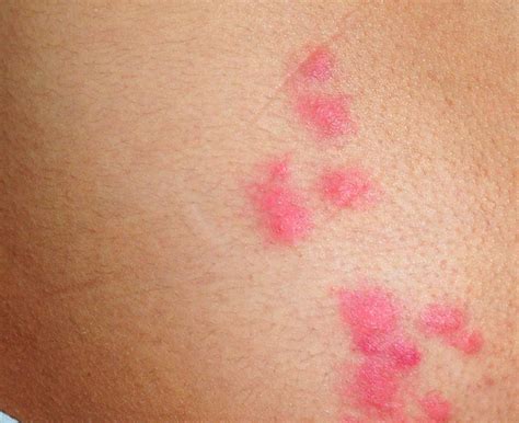 Bed Bug Bites Pictures Skin