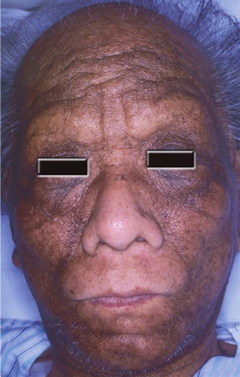 Clinical Features Of Malignant Acanthosis Nigricans Hyper Pigmen Ta