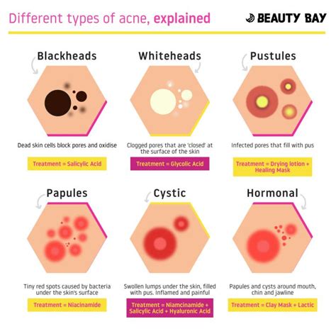 6 Different Types Of Acne Explained Beauty Bay Edited Different