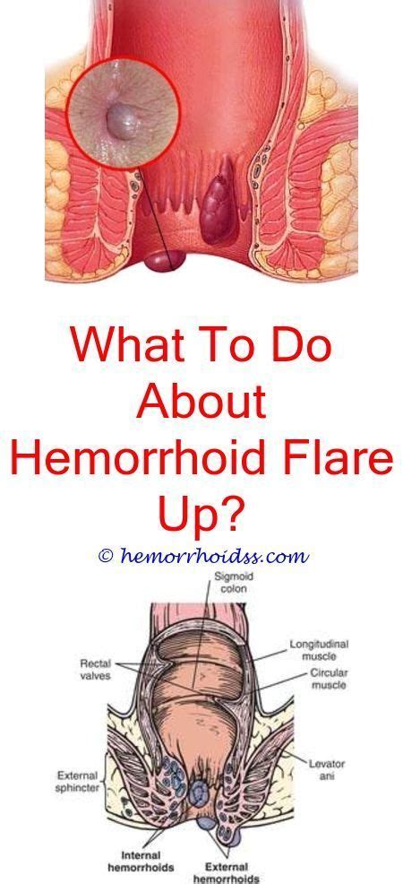 When You Need Surgery For Hemorrhoids How Do They Remove A Hemorrhoid How To Remove Hemorrhoid