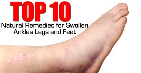 10 Top Natural Remedies For Swollen Ankles Legs And Feet