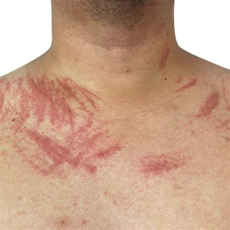 Superdrug Health Clinic Red Lines On Skin That Look Like Scratches