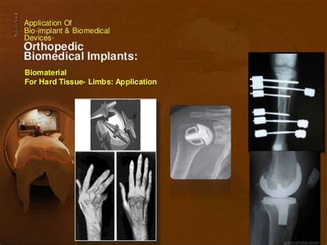 Application Of Bio Implant And Biomedical Devices Recent Advancement A