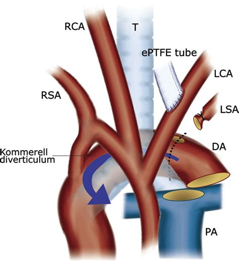 Aortic Arch Reconstruction Using A Kommerell Diverticulum For