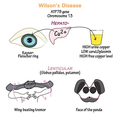 Neuroanatomy Glossary Wilsons Disease Ditki Medical And Biological