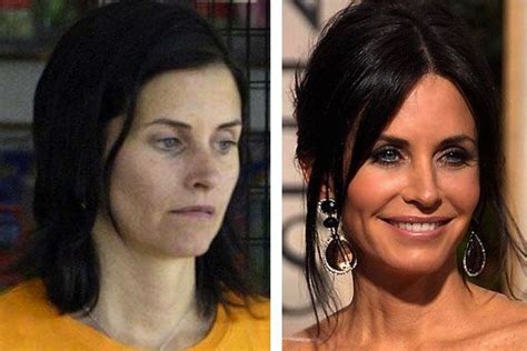 Pin on Botox Natural Alternative Before After Results