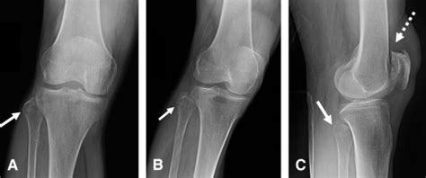 Arcuate Sign In Posterolateral Corner Injury Of The Knee Journal Of