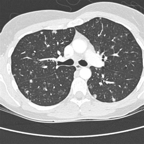 Eosinophilic Granuloma Of The Lung Pacs