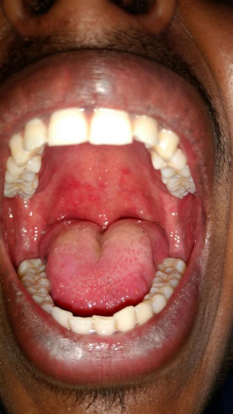 Mouth Ulcers On Back Of Throat