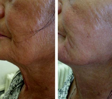 Laser Face Lift In San Diego Before And After Facelift Info Prices