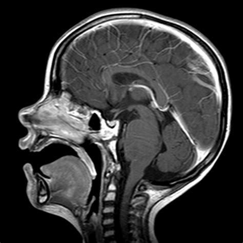 Brainstem glioma | Image | Radiopaedia.org