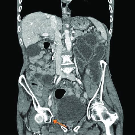 Computed Tomography Of Abdomen And Pelvis Axial View Showing