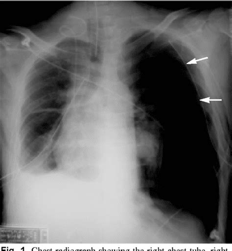 Pdf Tension Pneumothorax Complicated By Double Lumen Endotracheal