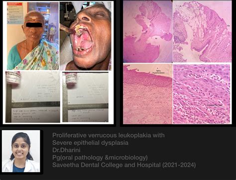 Proliferative Verrucous Leukoplakia With Severe Epithelial Dysplasia