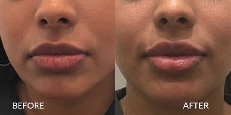 Botox For Lip Lines Botox Upper Lip Side Effects Boto