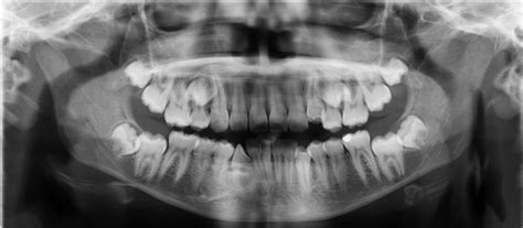 Imaging In Oral And Maxillofacial Surgery Pocket Dentistry
