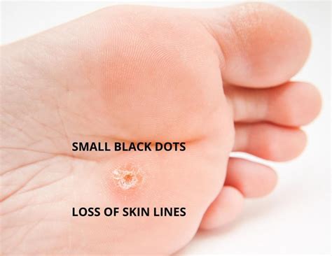 Wart Foot Black Dots Wart On Foot Black Dots