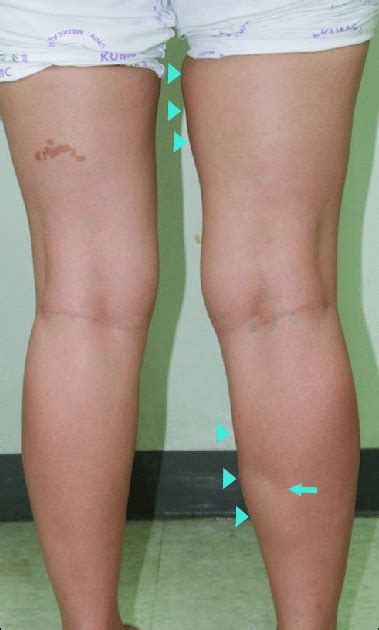 Mild Swelling Is Exhibited On The Medial Side Of The Right Thigh And