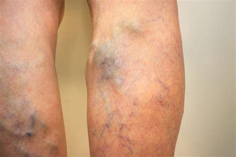 Venous Insufficiency And When To See A Vascular Specialist Njvvc