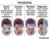 Ice Pick Migraine Treatment
