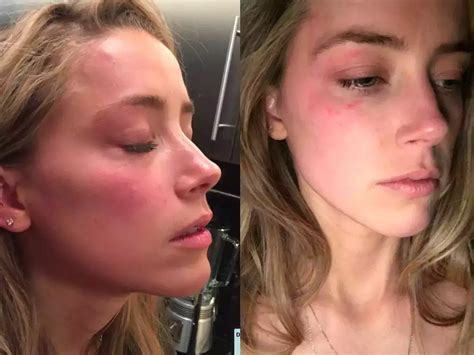 amber heard s lawyers share photos of the actress with red bruises on her face allegedly