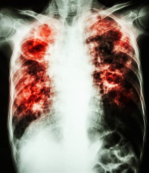 Provided by the centers for disease control and tuberculosis cases and case rates, surveillance summaries, trends in tb (fact sheet). Research May Yield New Ways to Treat Antibiotic-Resistant TB